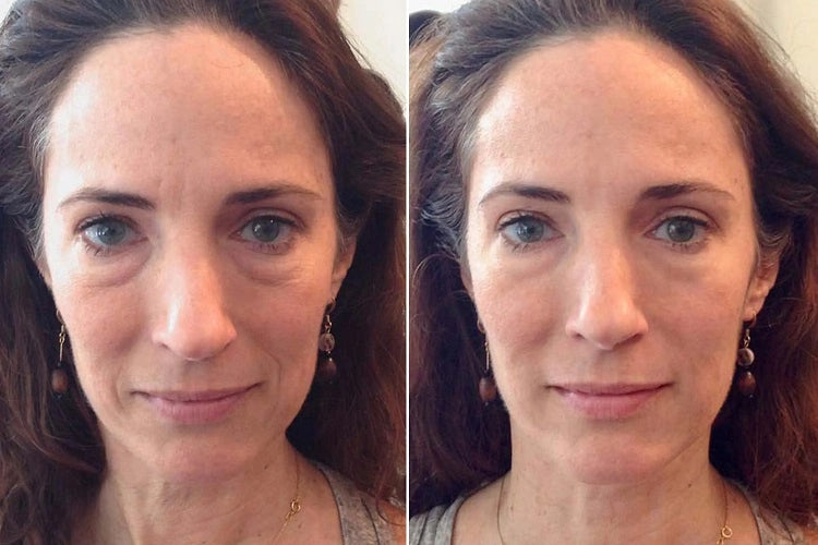 massage-visage-antiride-avant-apres.webp
